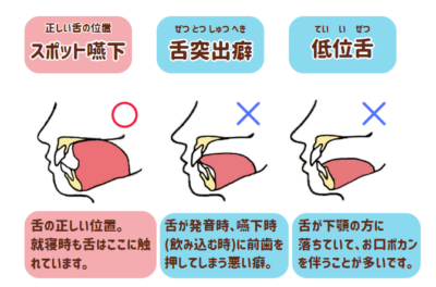 お家でできる お口のトレーニング、MFT - 歯ならび肌管理クリニックブログ